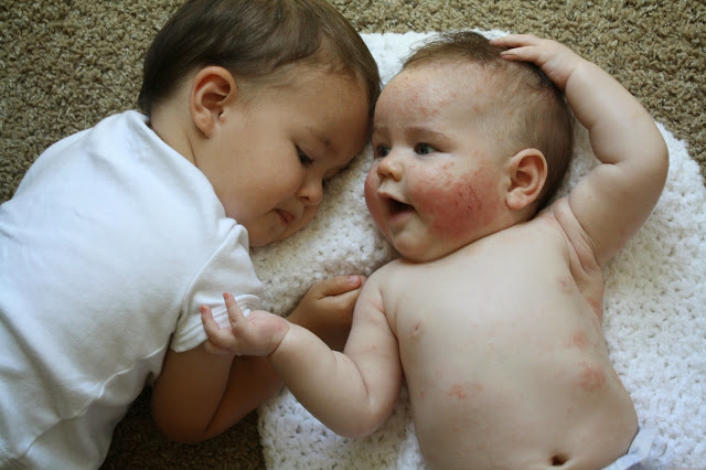 How I fight infant and toddler eczema 